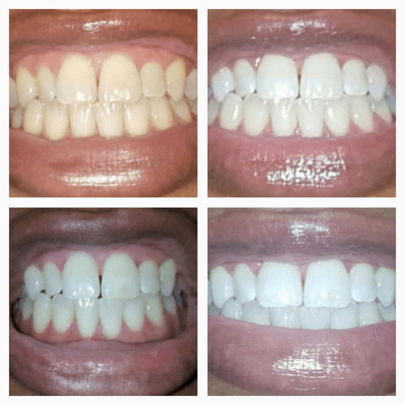 Extra-Strength Teeth Whitening Serum Pen